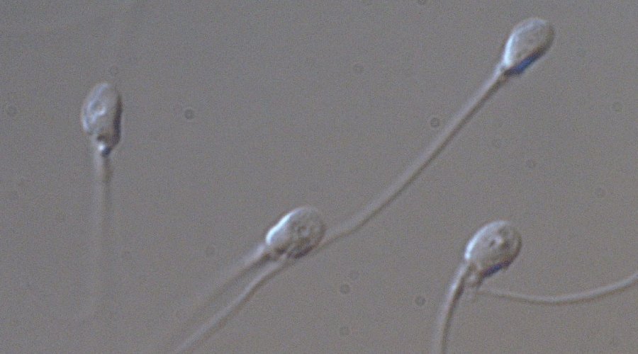 Intracytoplasmic Morphologically Sperm Injection (IMSI)