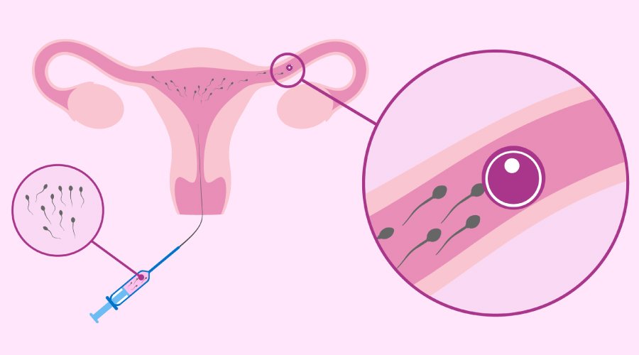 Intrauterine Insemination (IUI)