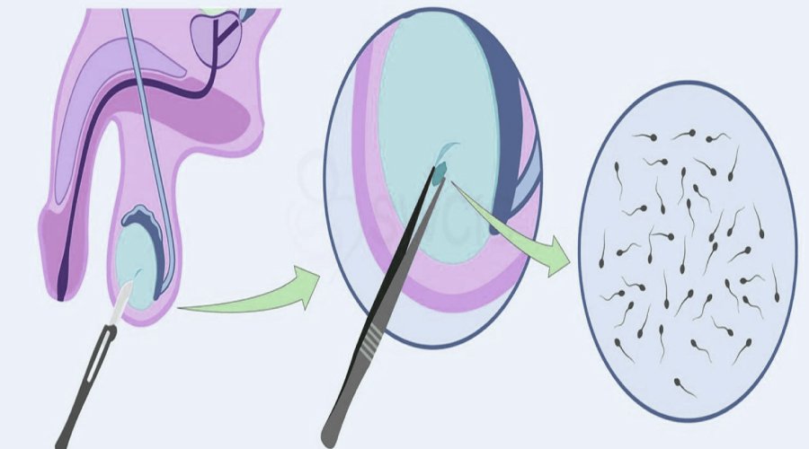 Surgical Sperm Retrieval